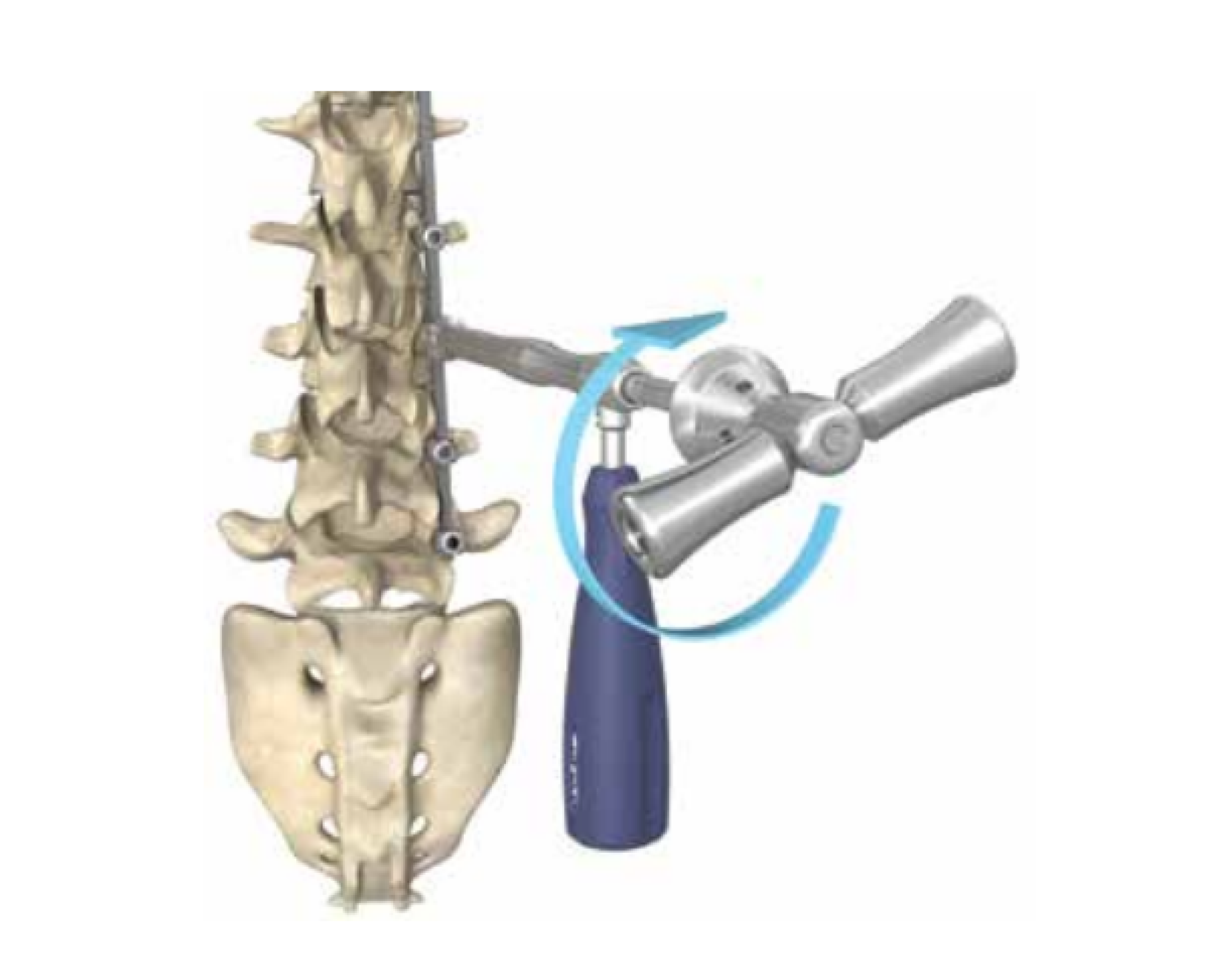 image of Stryker Spinal instruments Xia Torque wrench tightening a rod in place along the spine